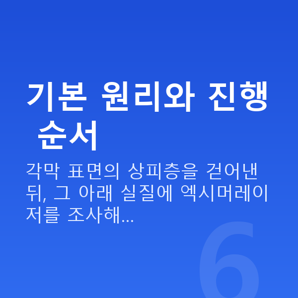 올레이저라섹수술방법 기본 원리와 진행 순서