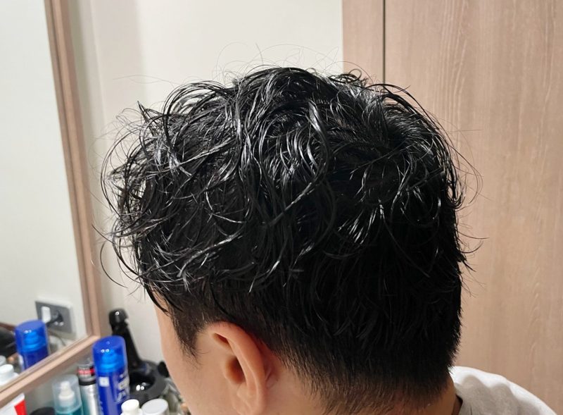 산후탈모 — 산후탈모라는 표현